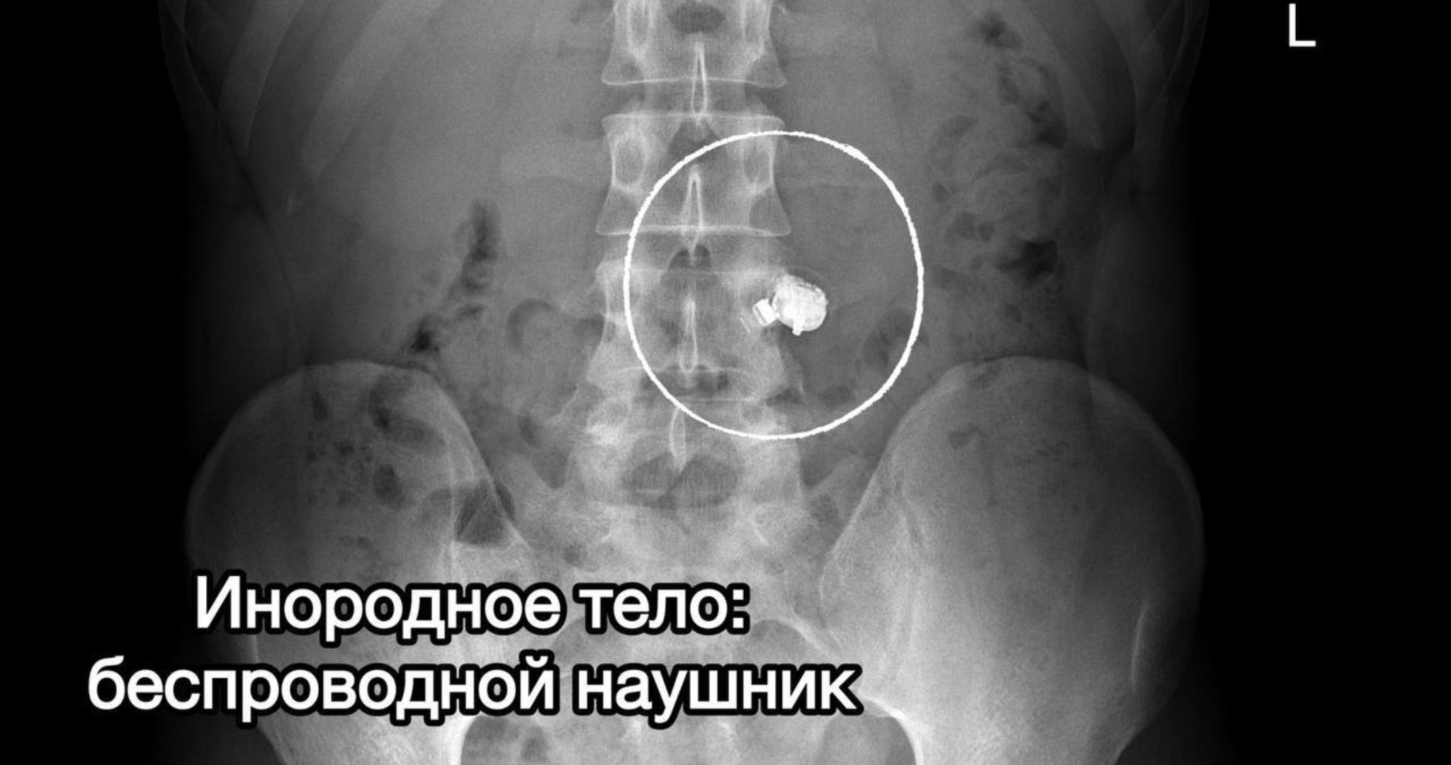 Наушники и черенок ложки: медики назвали странные предметы, найденные в пациентах 