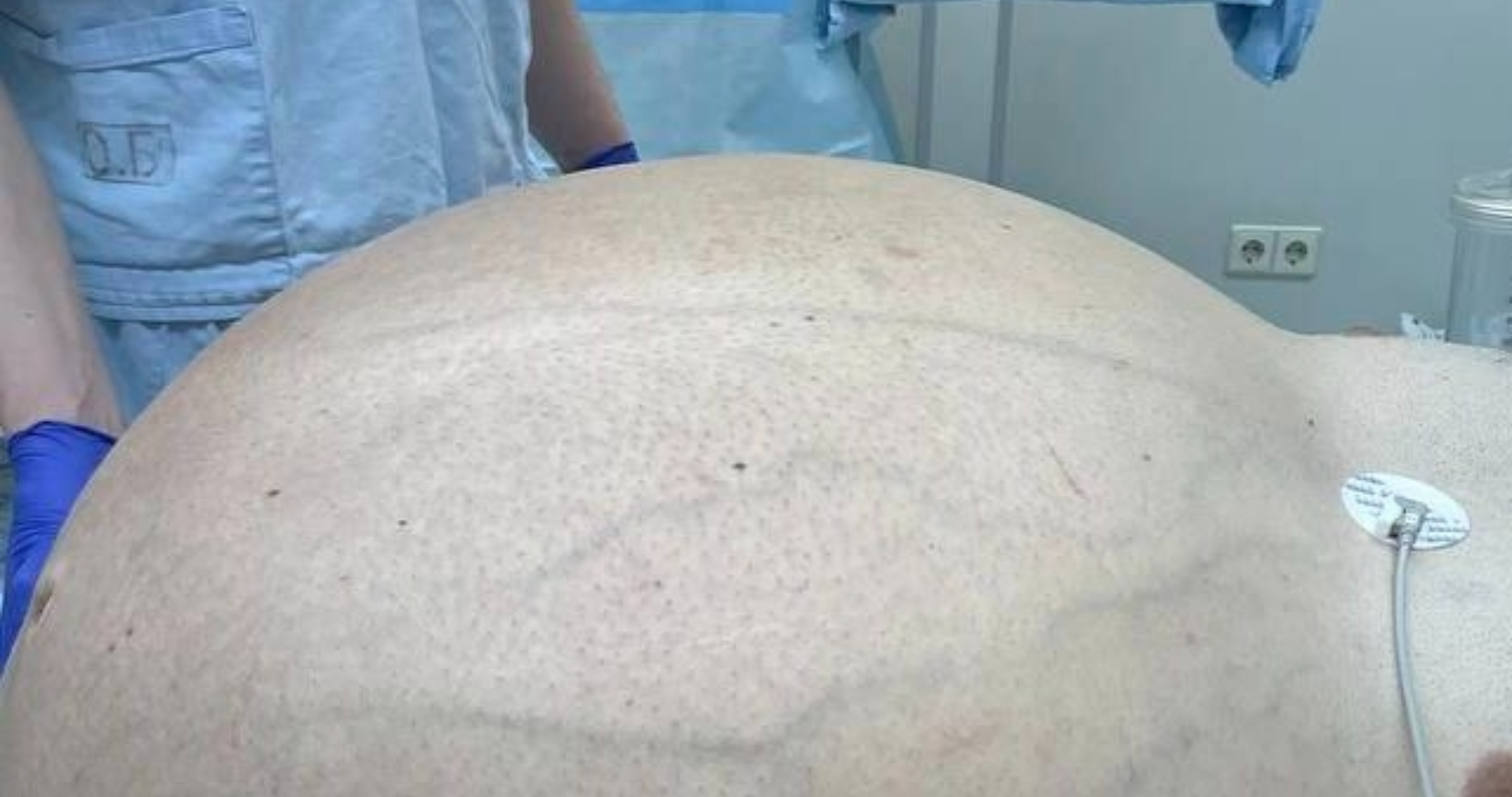 Россиянину удалили гигантскую 60-килограммовую опухоль 