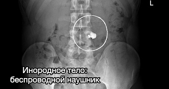 Наушники и черенок ложки: медики назвали странные предметы, найденные в пациентах 